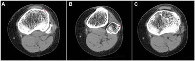 Localizing the position of the Segond fracture bed under CT measurements to determine the functional tibial insertion of an anterolateral ligament